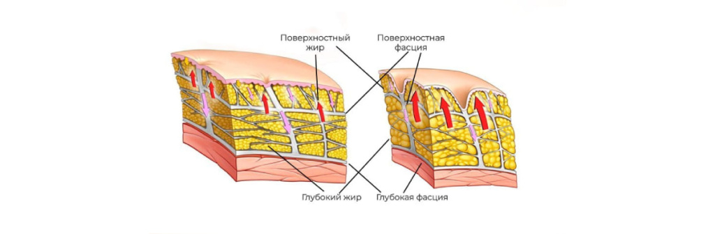 Целлюлит.jpg Целлюлит.jpg